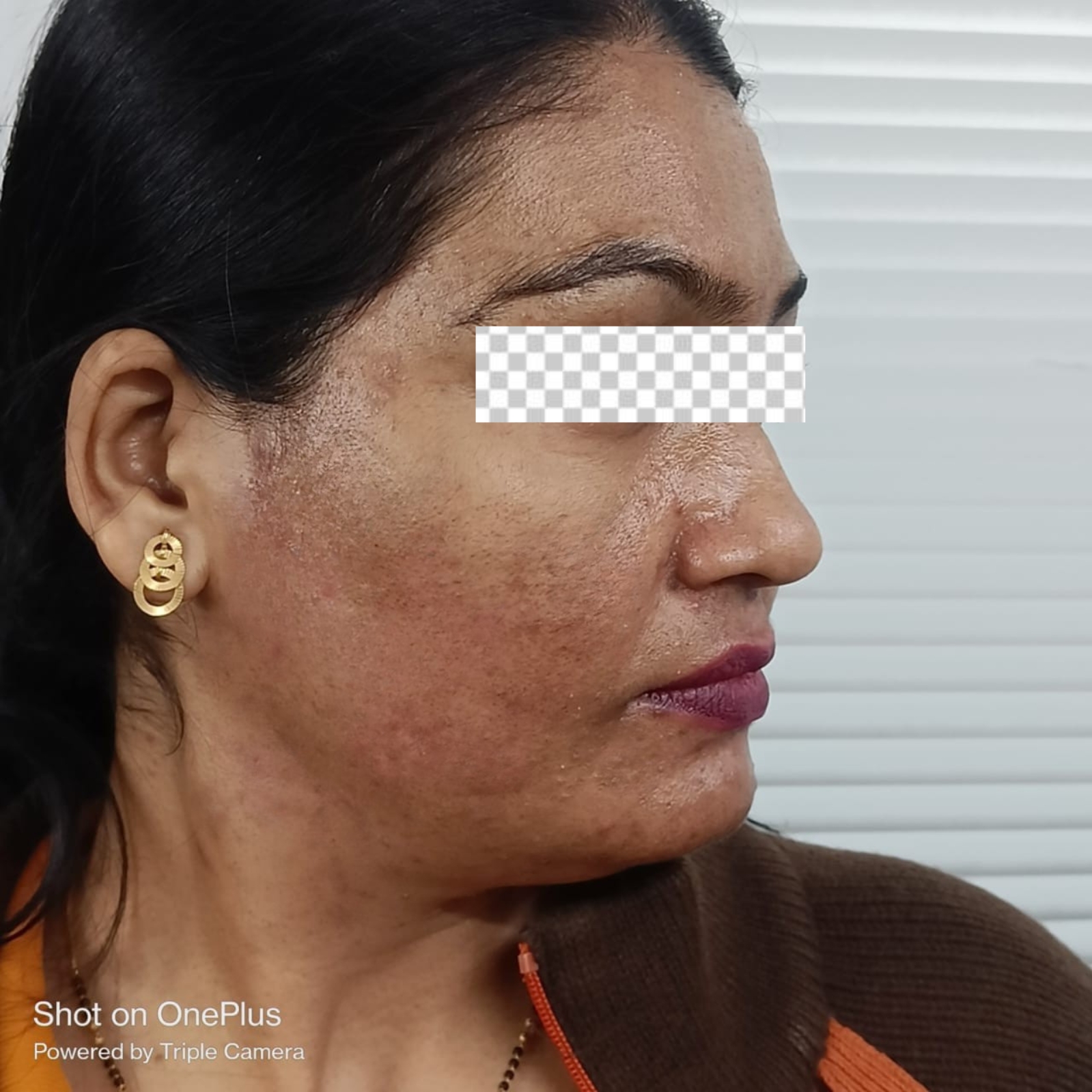 Face Acne 2