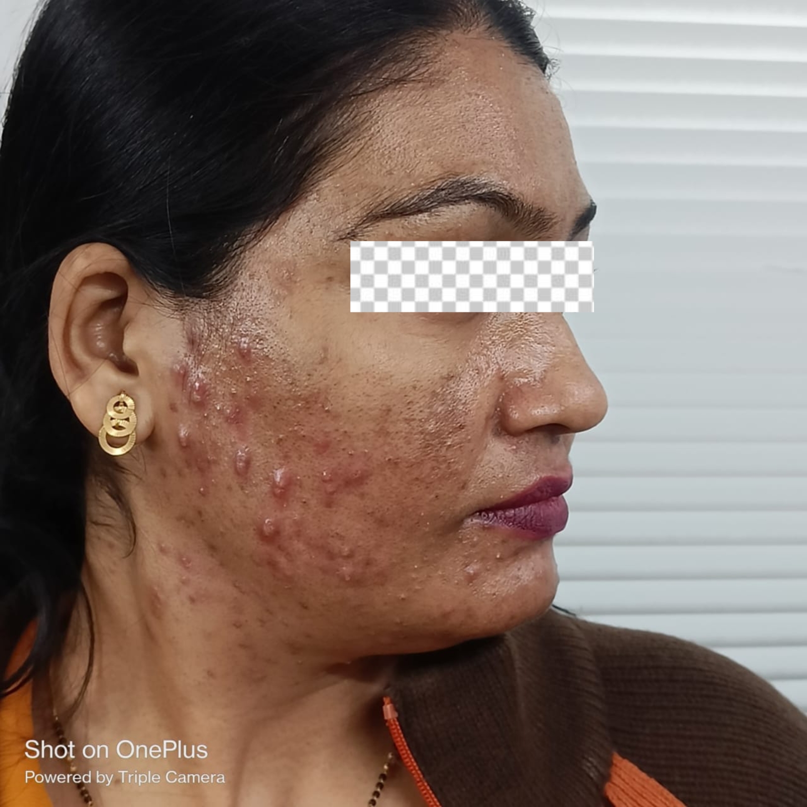 Face Acne