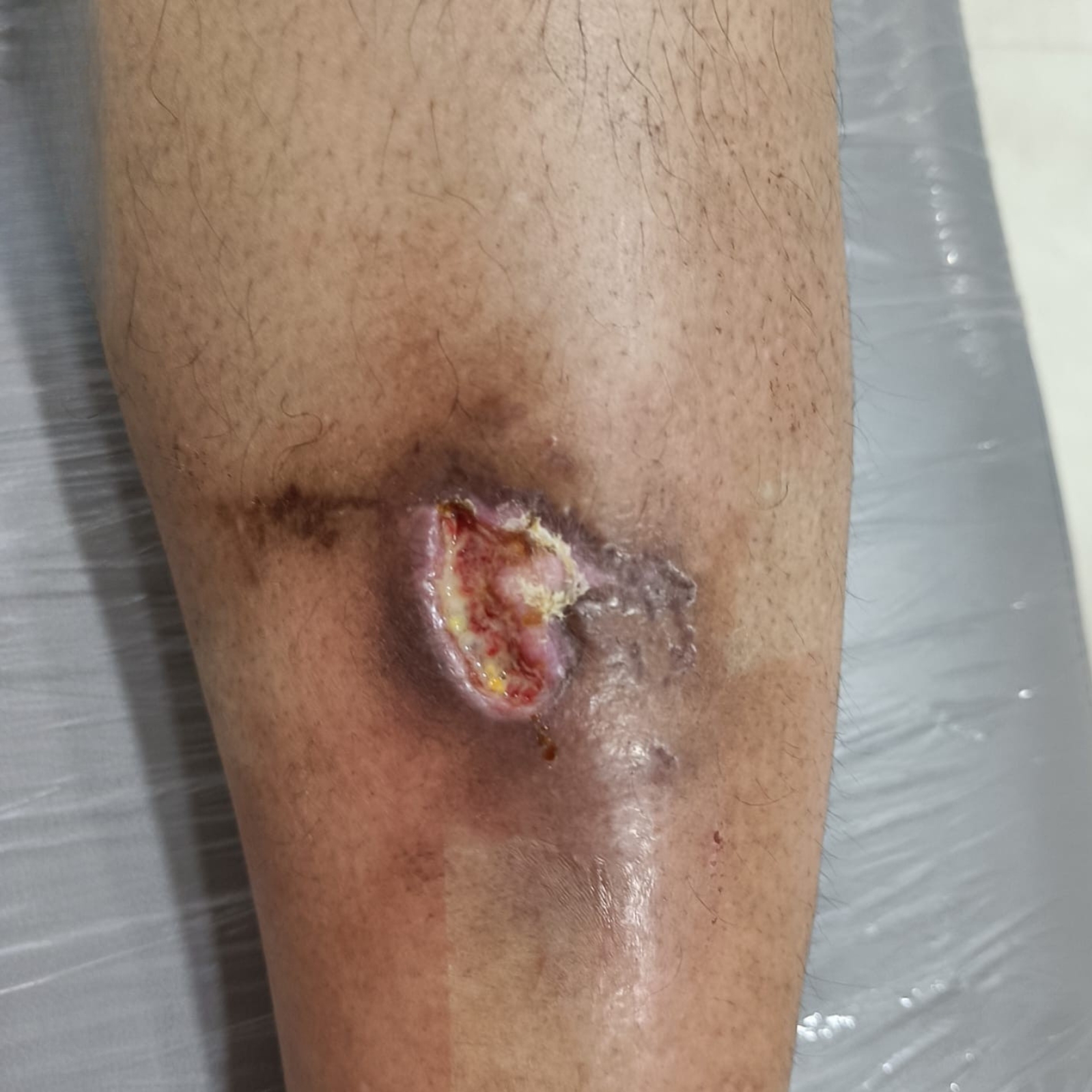 Leg 1