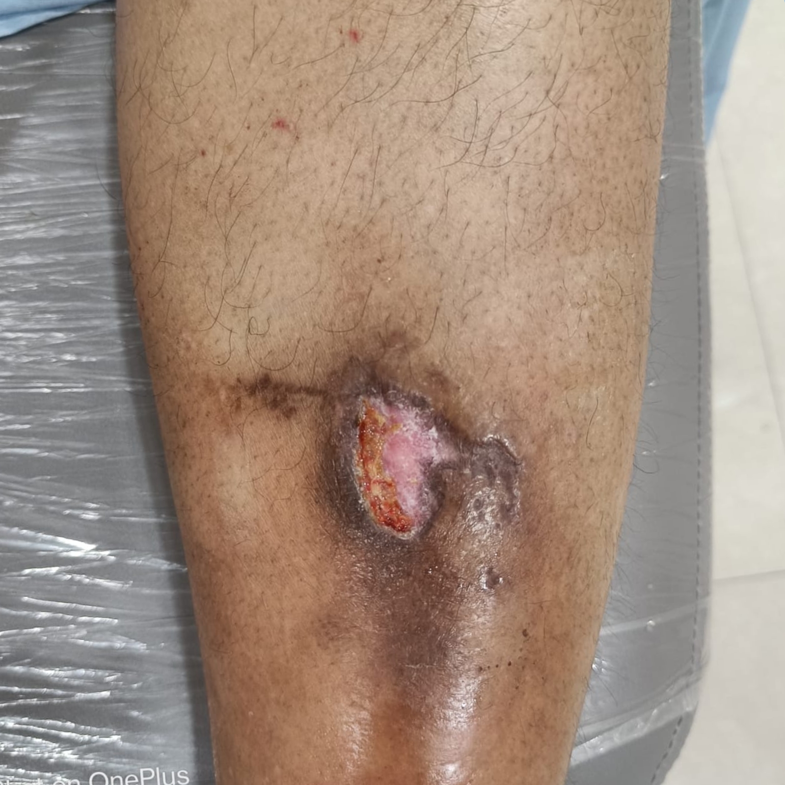 Leg2