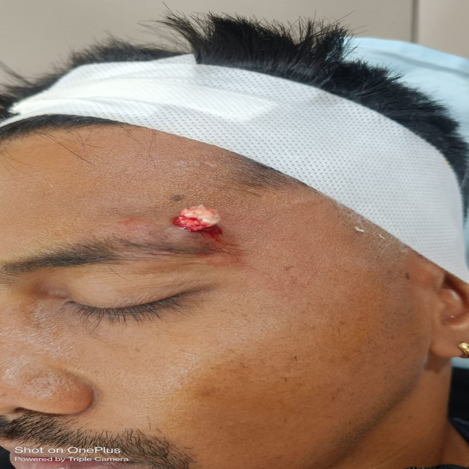 Sebaceous Cyst Removal 1