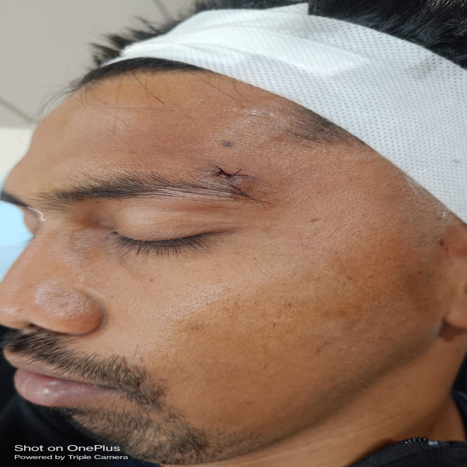 Sebaceous Cyst Removal 2
